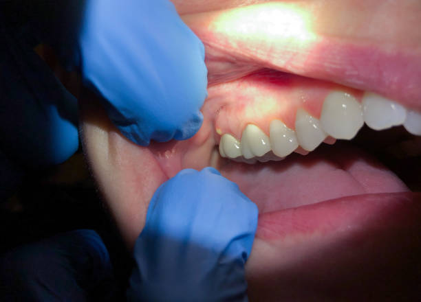 Best Emergency Treatment for Oral Infections in Bogata, TX